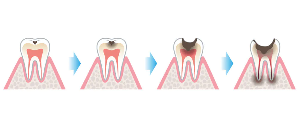【進行度別】虫歯の症状と治療にかかる期間