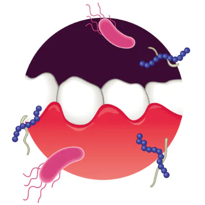 歯が抜ける前兆は「歯茎の腫れ」