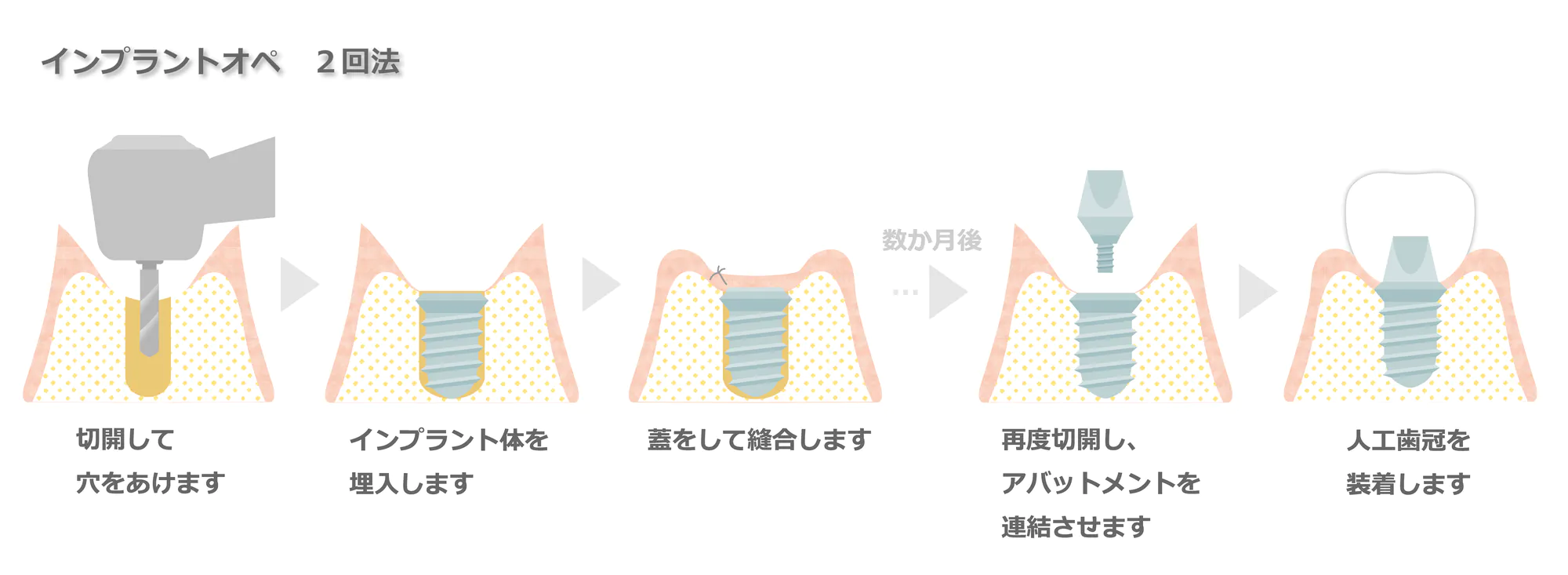 インプラント治療の流れ